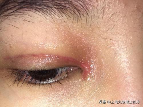 祛疤先进技术重塑美丽，开启美丽新篇章