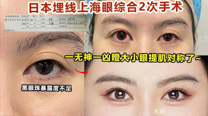 大小眼手术价格详解，你想知道的所有信息都在这里！